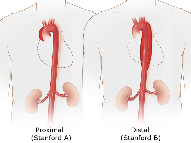 Clasificación de Stanford: tipo A (proximal, aorta ascendente) vs tipo B (distal)