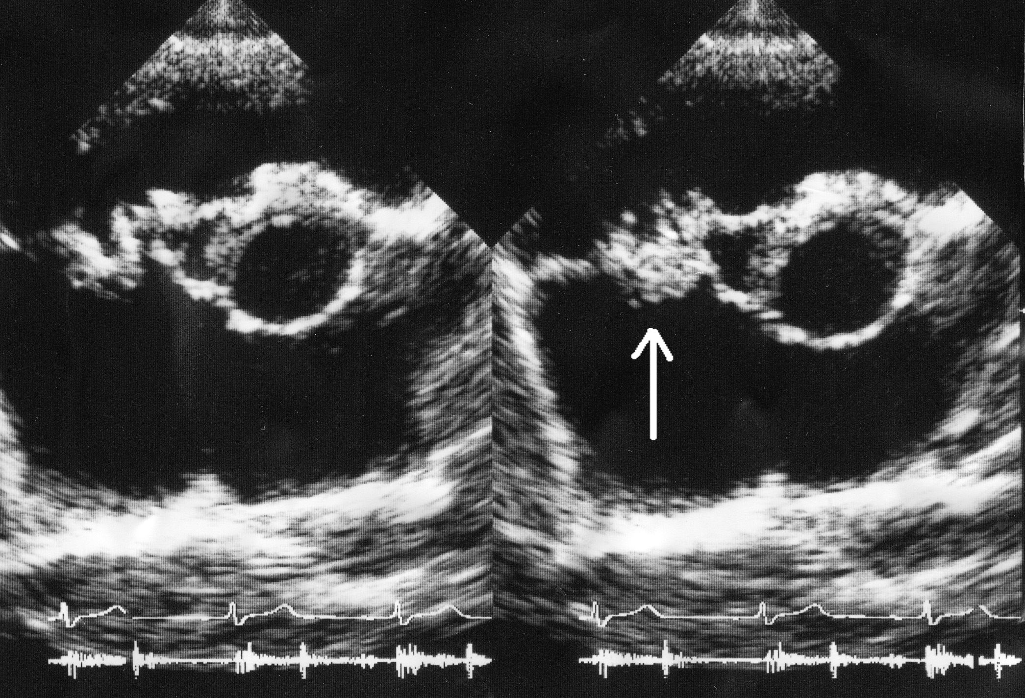Ecocardiograma: vegetación sobre la válvula tricúspide en endocarditis infecciosa