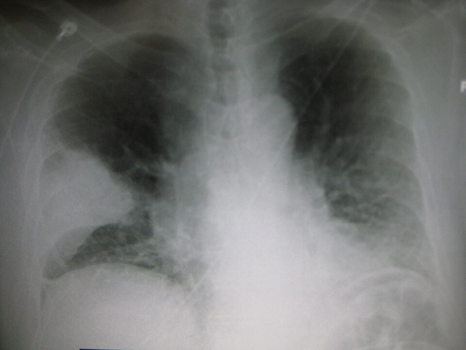 Radiografía de tórax: condensación (consolidación) del lóbulo medio derecho