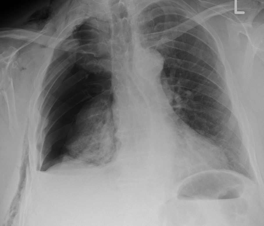 Radiografía de tórax: neumotórax derecho con pulmón colapsado