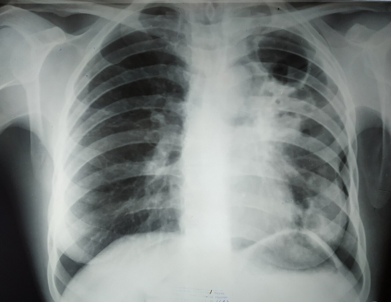 Radiografía de tórax: tuberculosis fibrocavitaria del lóbulo superior