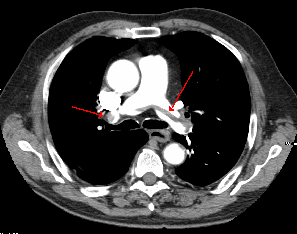 AngioTC de tórax: tromboembolismo pulmonar en silla de montar