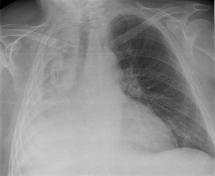 Radiografía: atelectasia con hemitórax opaco y desviación del mediastino hacia la lesión
