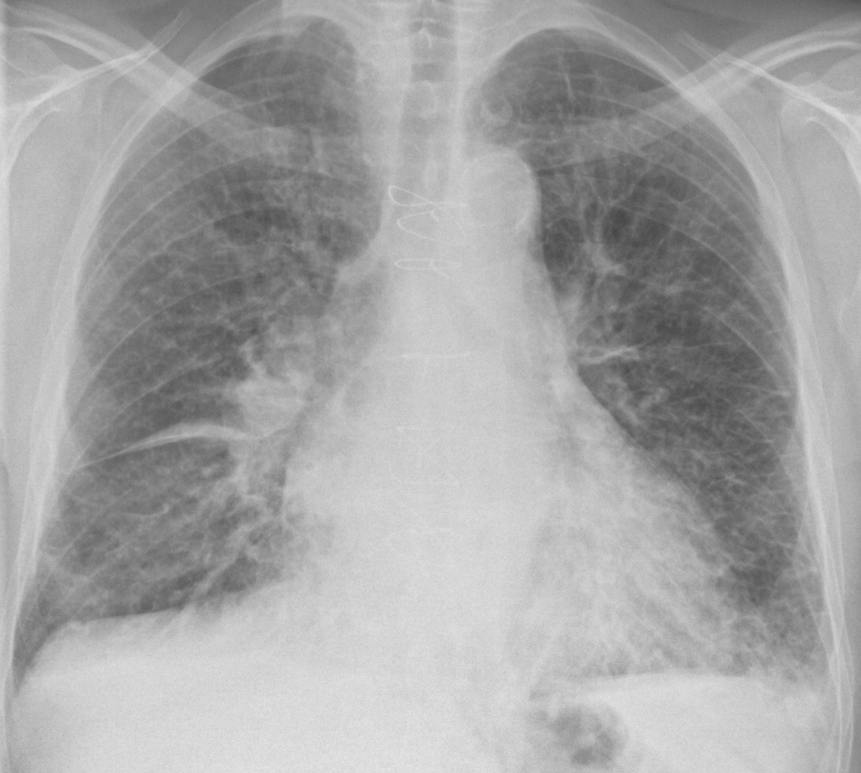Radiografía: edema pulmonar con cefalización y líneas B de Kerley