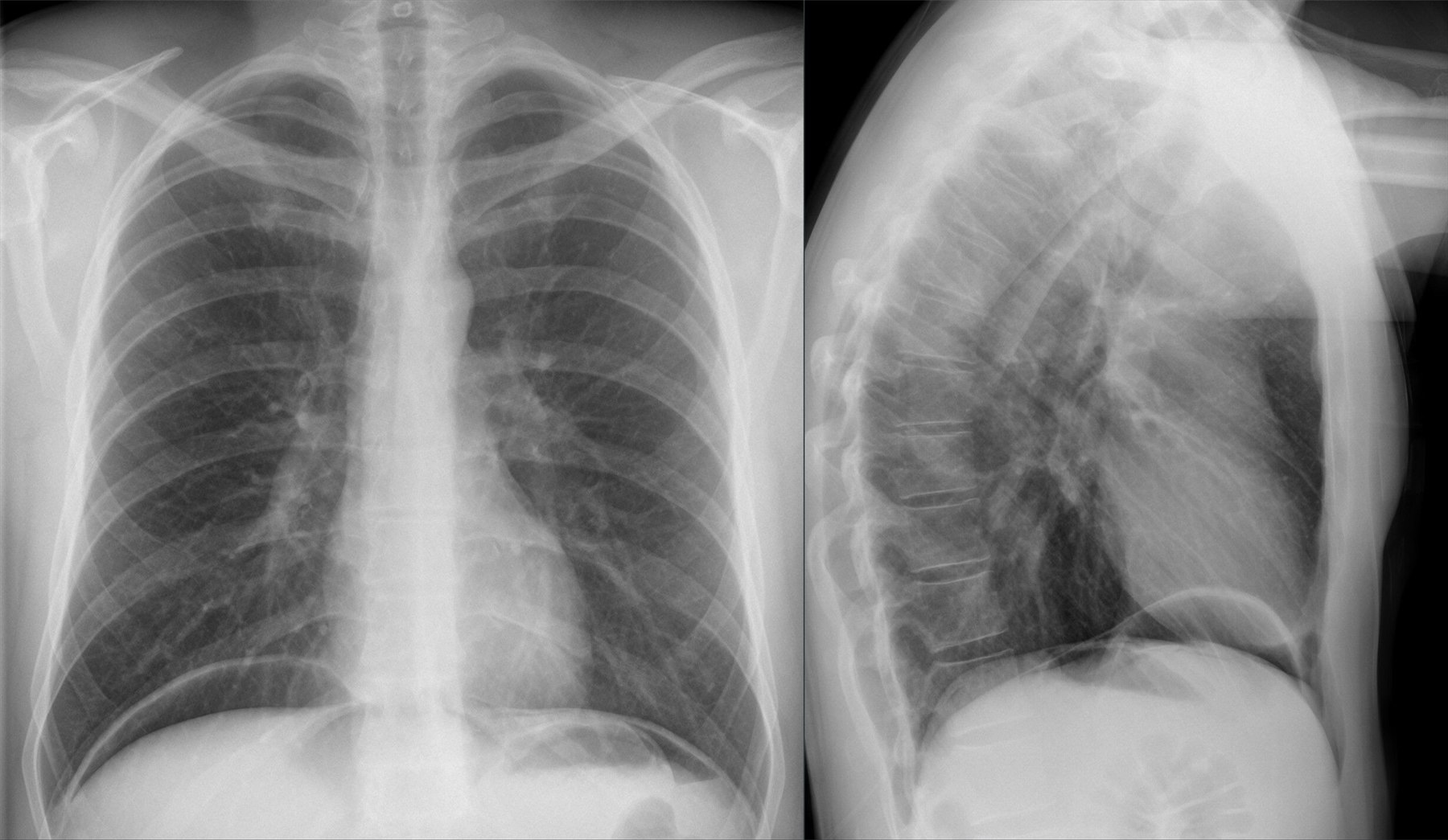 Radiografía de pie: semiluna de aire libre bajo el hemidiafragma derecho (neumoperitoneo)