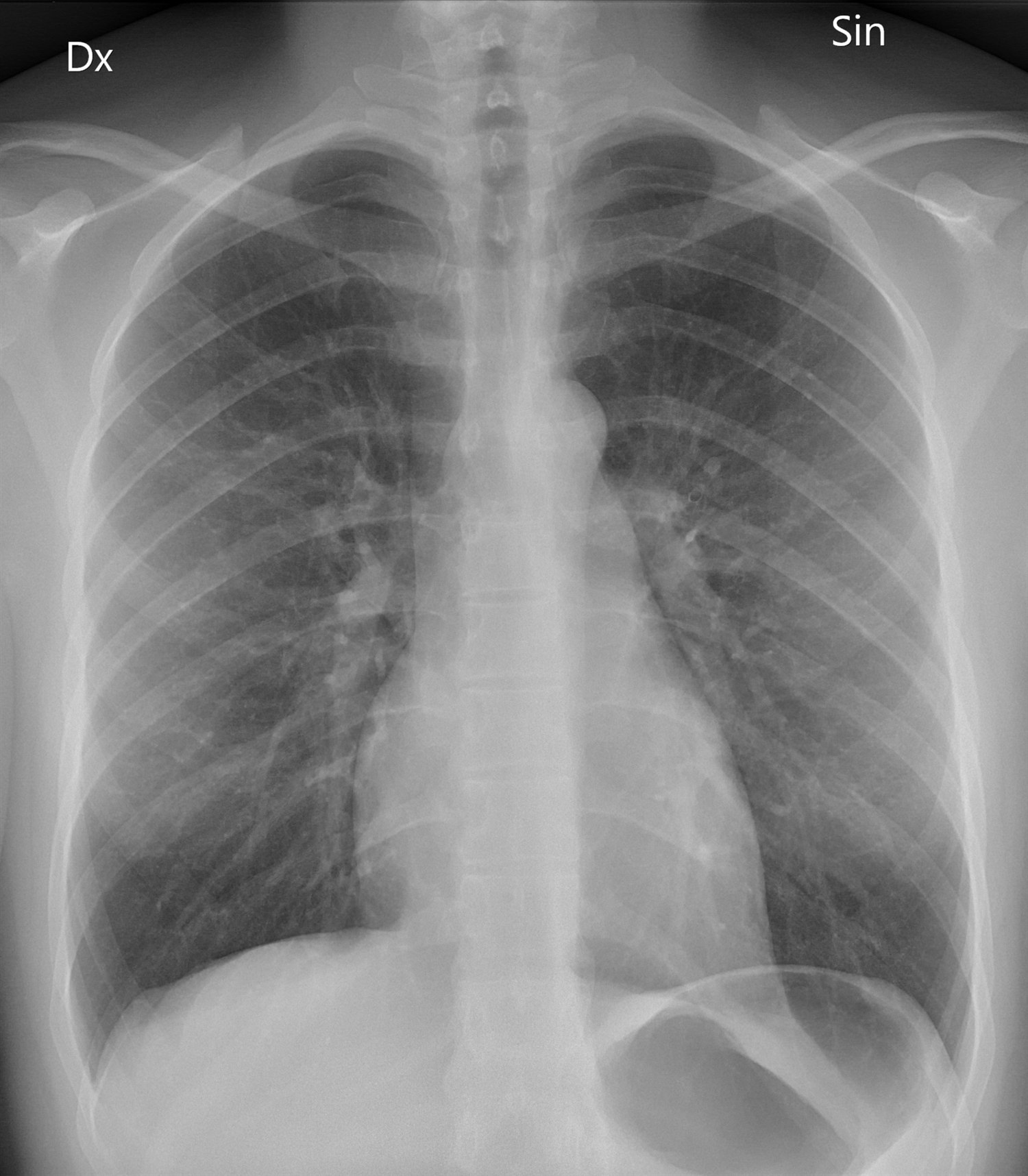 Radiografía de tórax PA normal y bien tomada, con marcas de calidad técnica