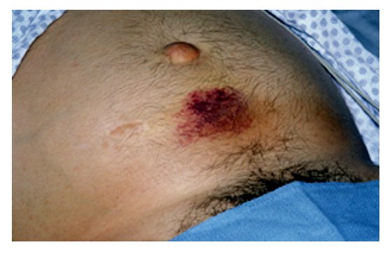 Equimosis periumbilical (signo de Cullen)
