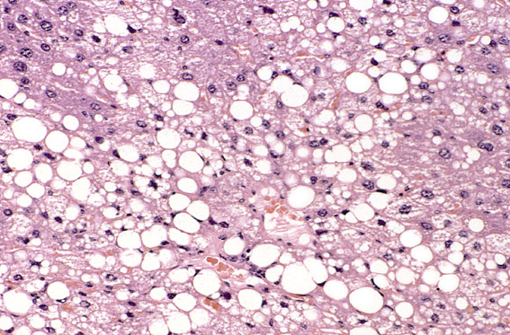Histología de esteatosis hepática con vacuolas de grasa macrovesiculares