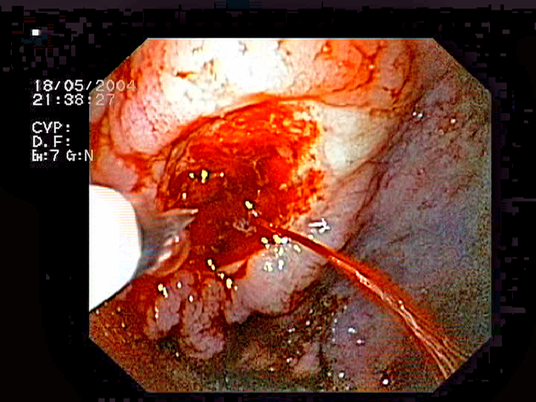 Úlcera gástrica con sangrado activo en la endoscopia