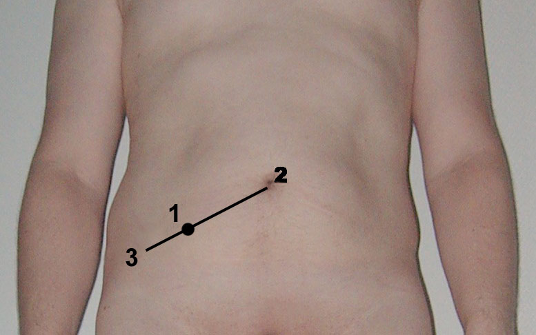 Punto de McBurney sobre el abdomen