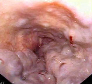 Várices esofágicas en la endoscopia