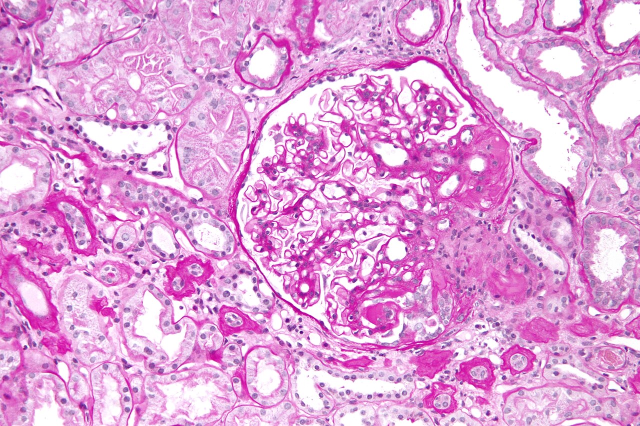 Biopsia renal con glomeruloesclerosis focal y segmentaria