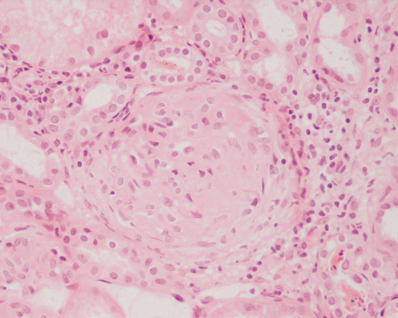 Biopsia renal: glomerulonefritis con semiluna que comprime el ovillo