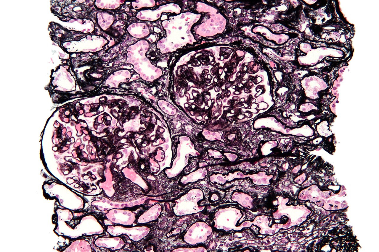 Biopsia renal: glomerulopatía membranosa con spikes en plata-metenamina