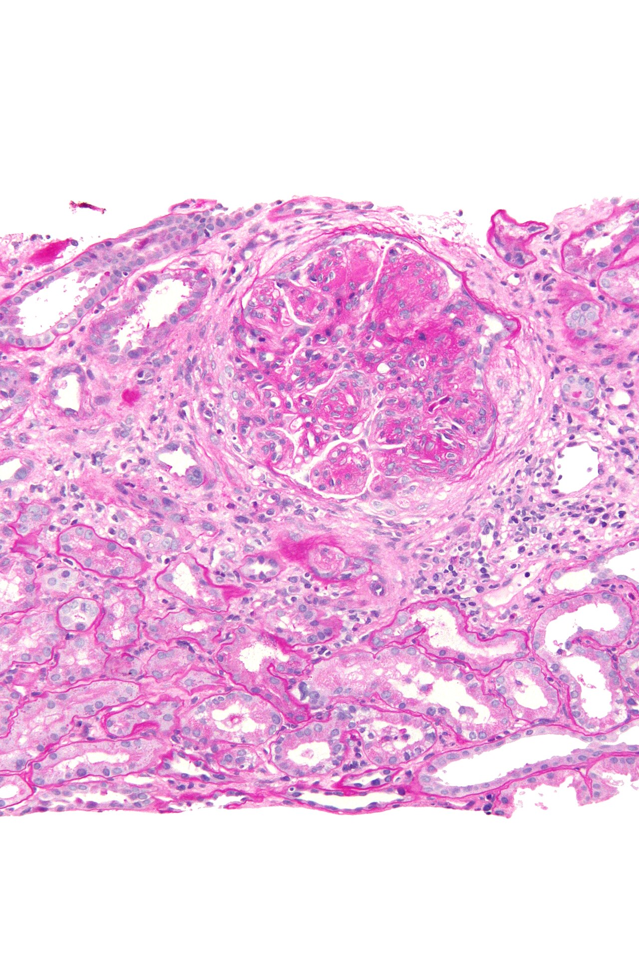 Biopsia renal: glomerulonefritis membranoproliferativa, glomérulo hipercelular y lobulado