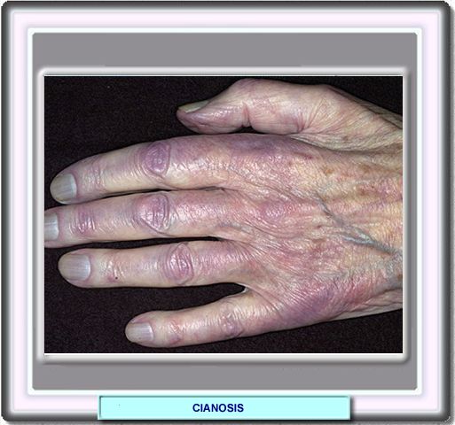Cianosis acra