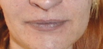 Facies cianótica