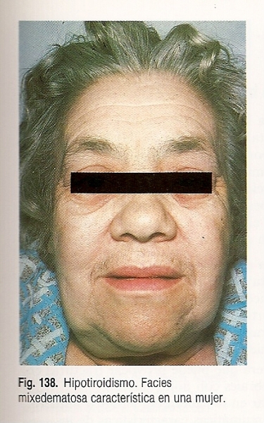 Facies mixedematosa