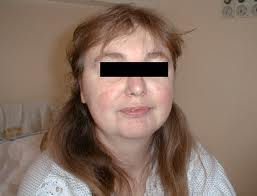 Facies cushingoide