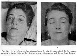 Facies miasténica