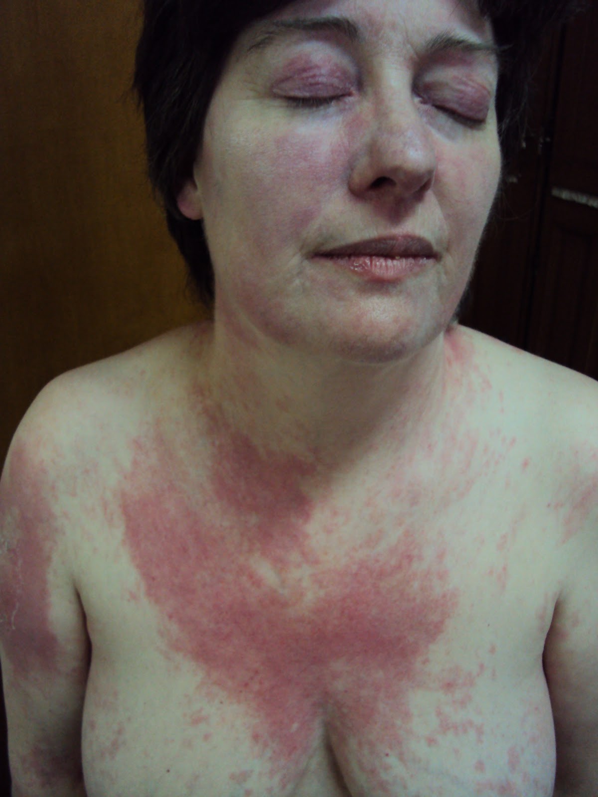 Facies de dermatomiositis