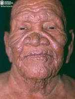Facies leonina